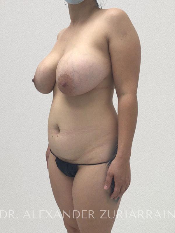 Tummy tuck before & after photo