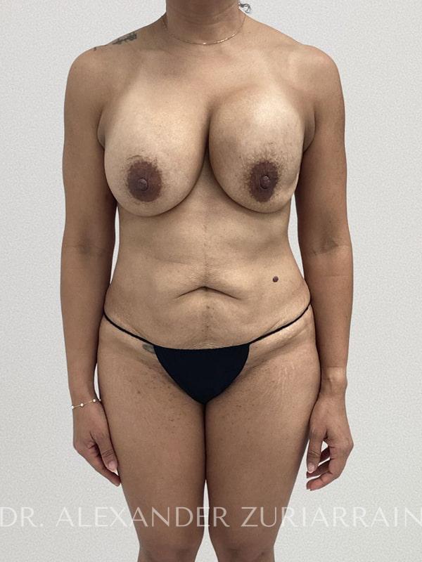 Tummy tuck before & after photo