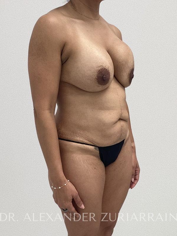Tummy tuck before & after photo