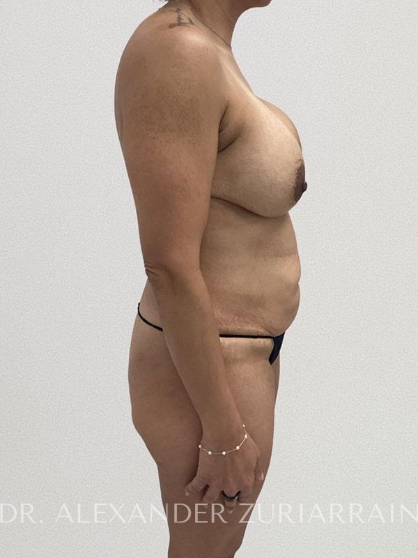 Tummy tuck before & after photo