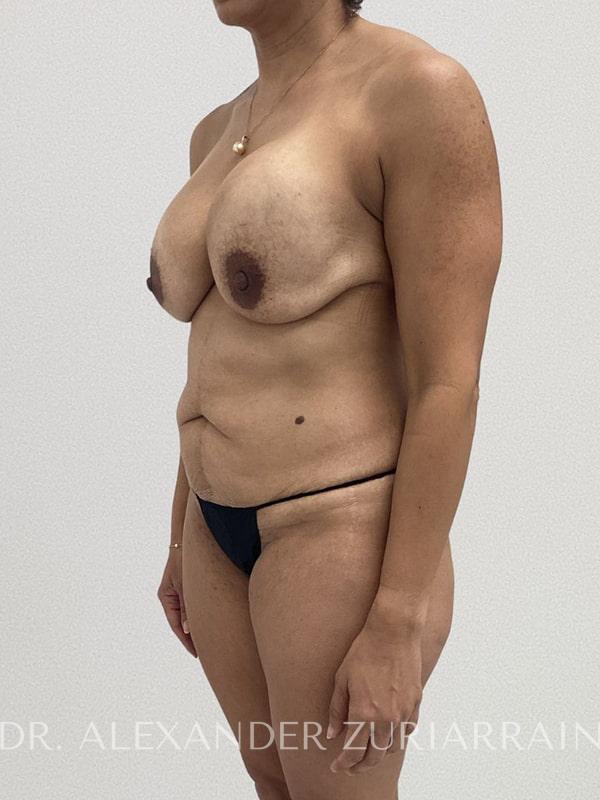 Tummy tuck before & after photo