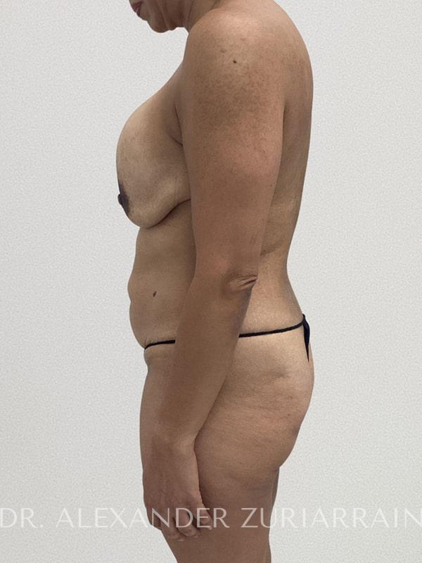 Tummy tuck before & after photo