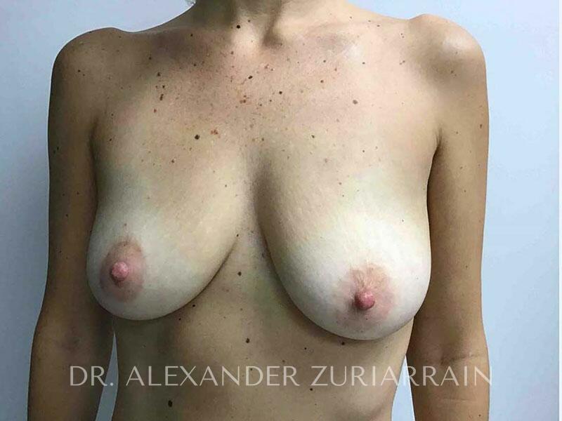 Breast augmentation before & after photo