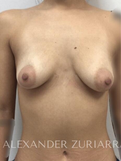 Breast augmentation before & after photo