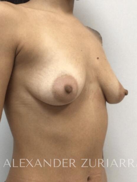 Breast augmentation before & after photo