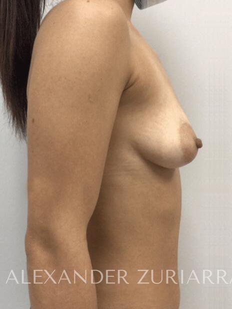 Breast augmentation before & after photo