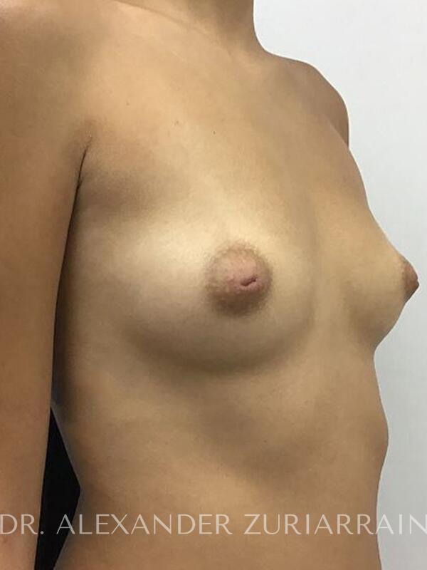 Breast augmentation before & after photo