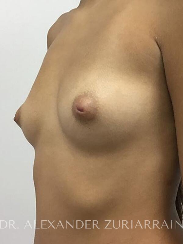 Breast augmentation before & after photo