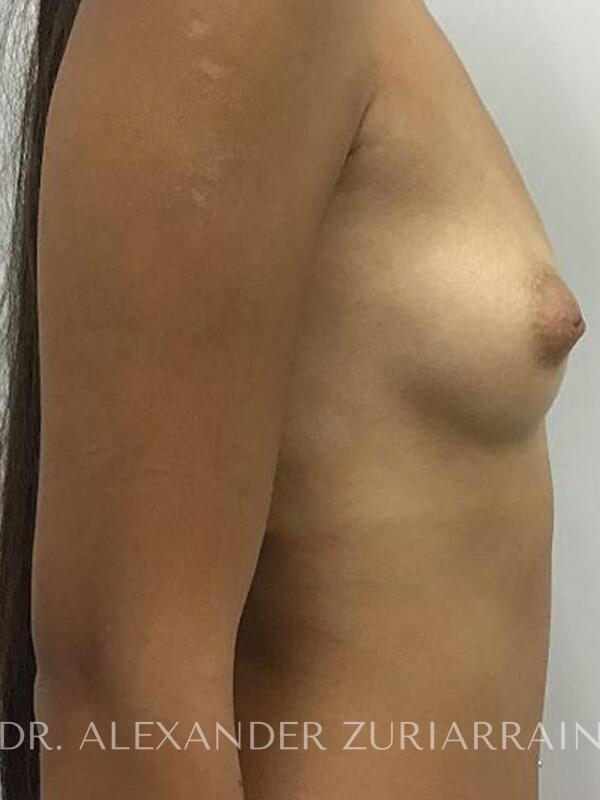 Breast augmentation before & after photo