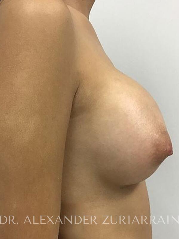 Breast augmentation before & after photo