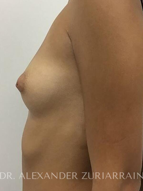 Breast augmentation before & after photo