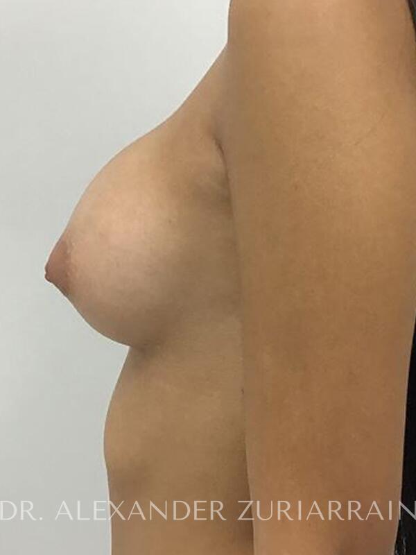 Breast augmentation before & after photo