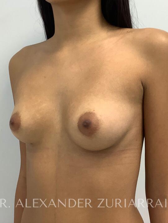 Breast augmentation before & after photo