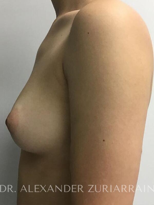 Breast augmentation before & after photo