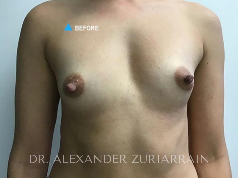 Breast augmentation before & after photo