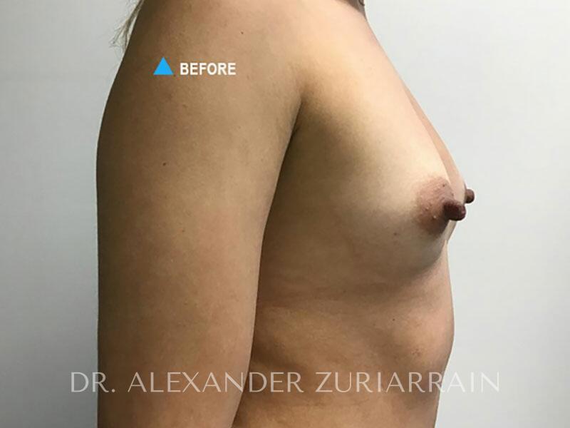 Breast augmentation before & after photo