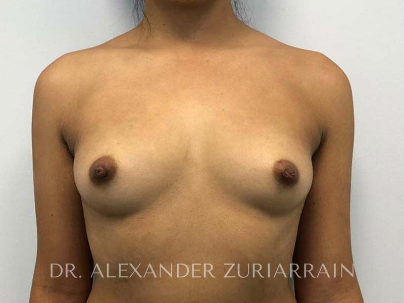 Breast augmentation before & after photo