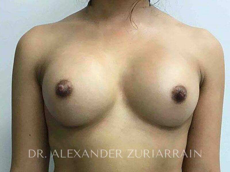 Breast augmentation before & after photo