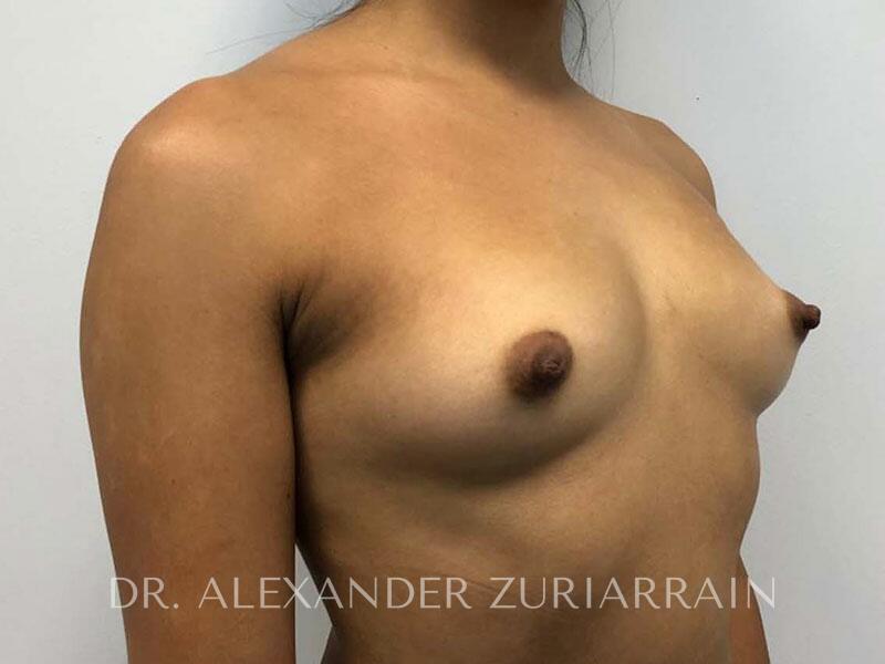 Breast augmentation before & after photo