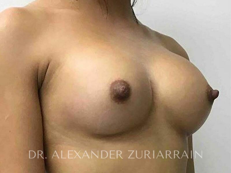 Breast augmentation before & after photo