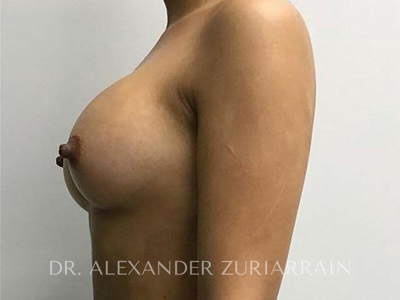 Breast augmentation before & after photo