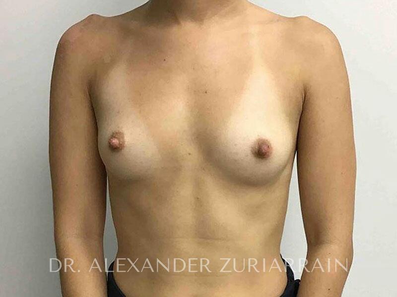 Breast augmentation before & after photo