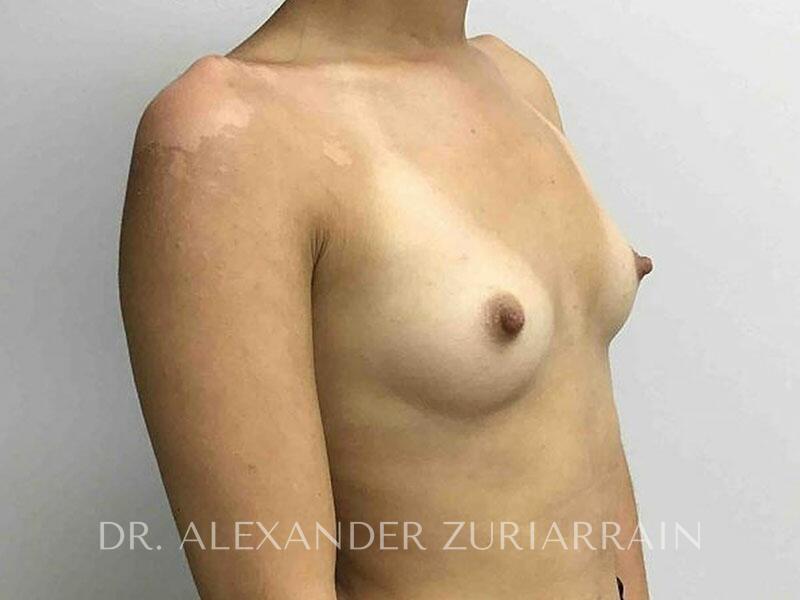 Breast augmentation before & after photo