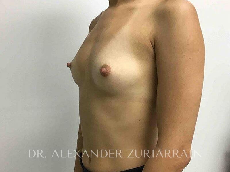 Breast augmentation before & after photo