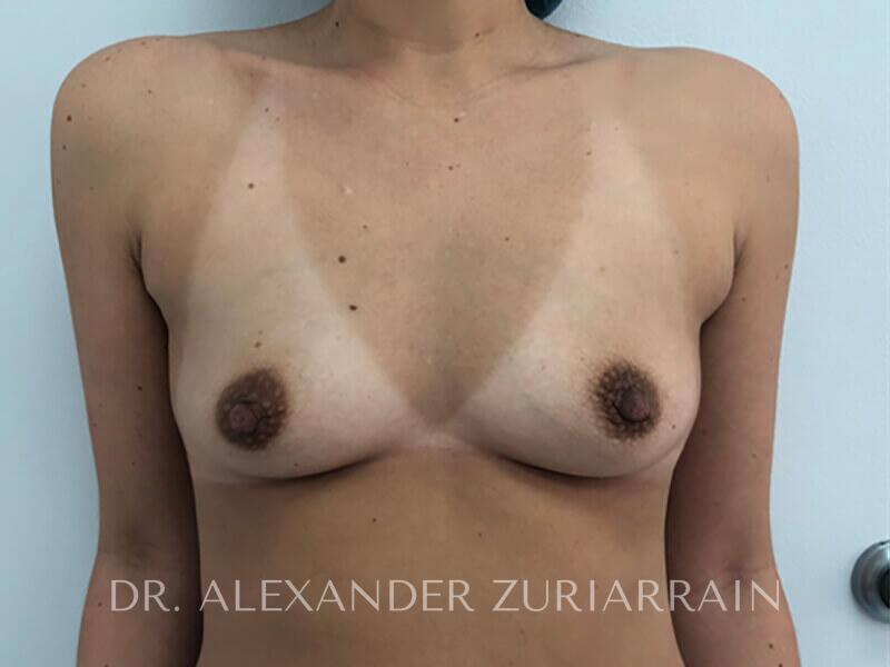 Breast augmentation before & after photo