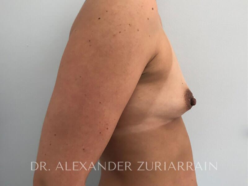 Breast augmentation before & after photo