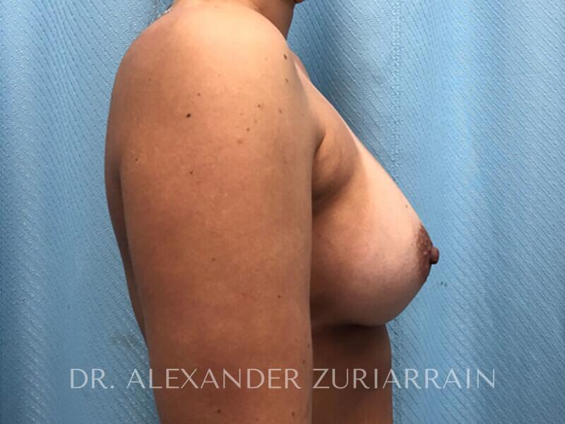 Breast augmentation before & after photo