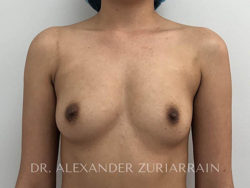 Breast augmentation before & after photo