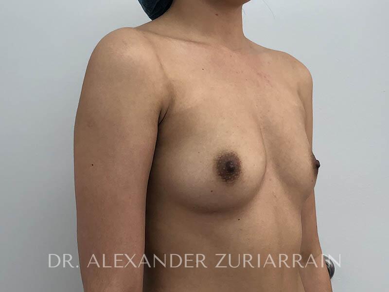 Breast augmentation before & after photo