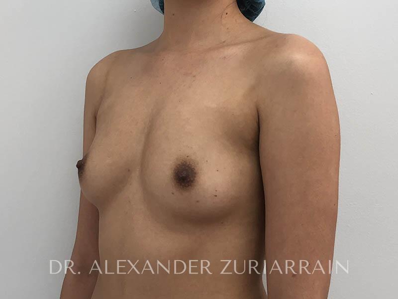 Breast augmentation before & after photo