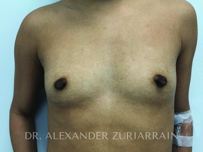 Breast augmentation before & after photo