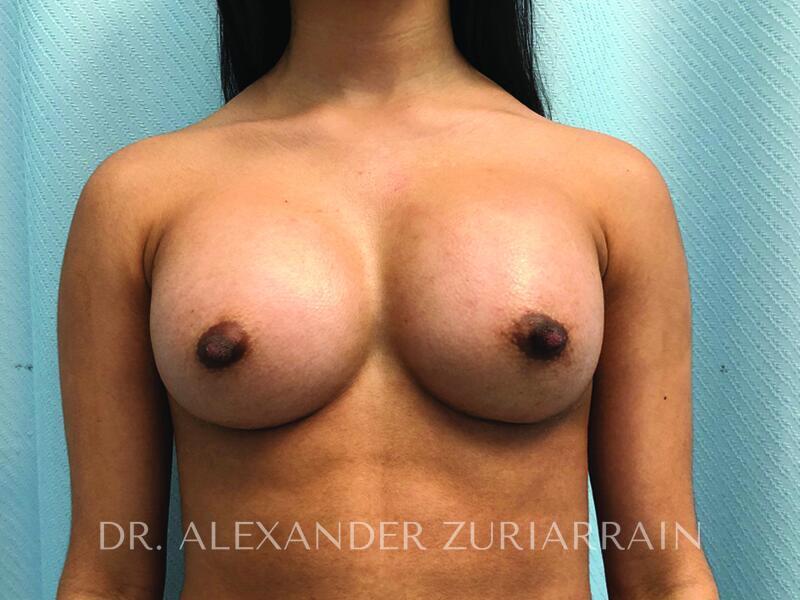 Breast augmentation before & after photo