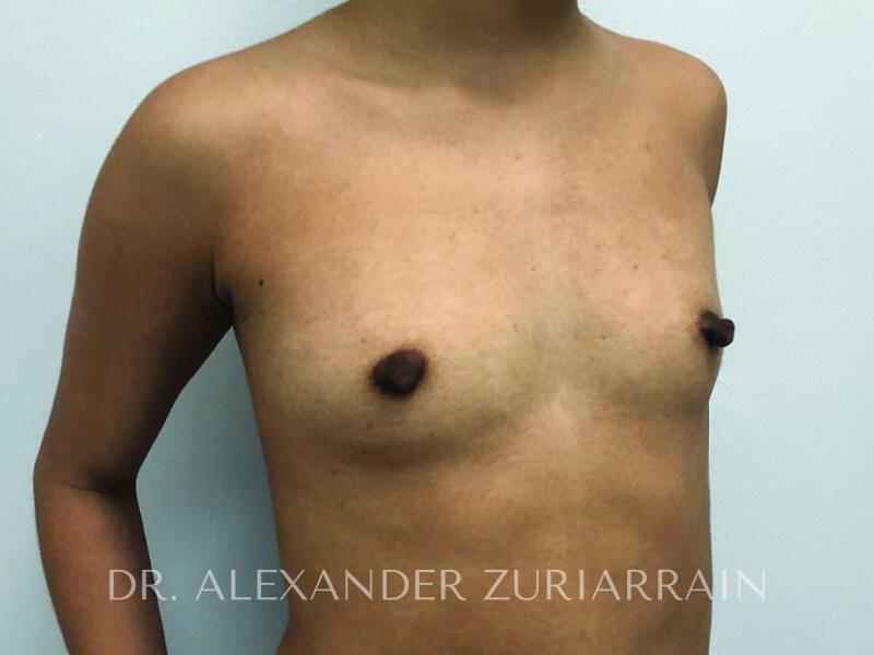 Breast augmentation before & after photo