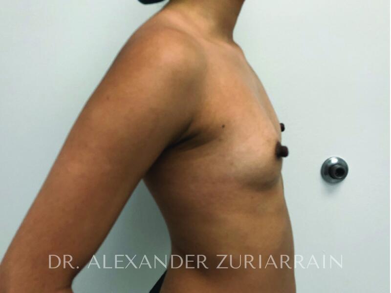 Breast augmentation before & after photo