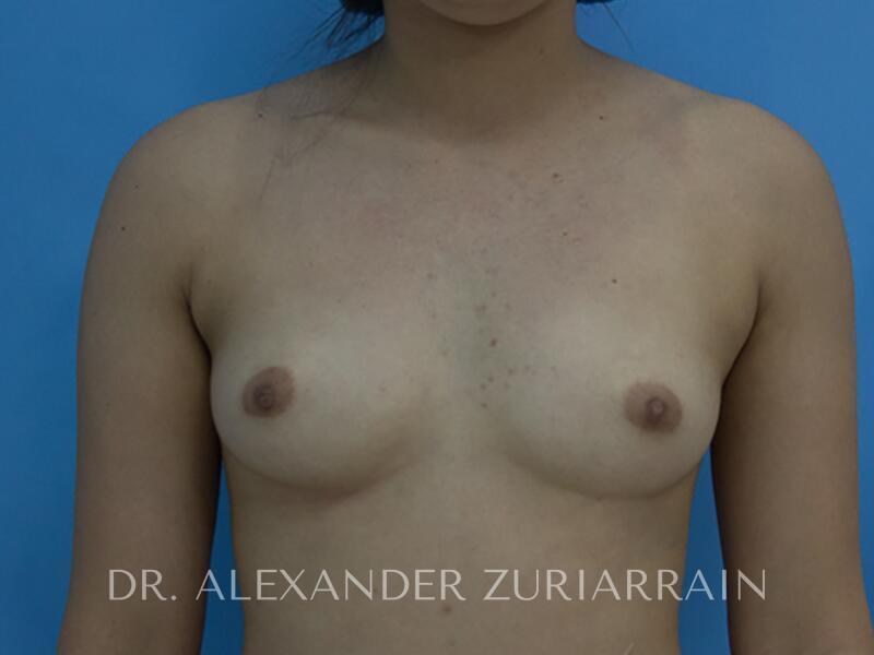 Breast augmentation before & after photo