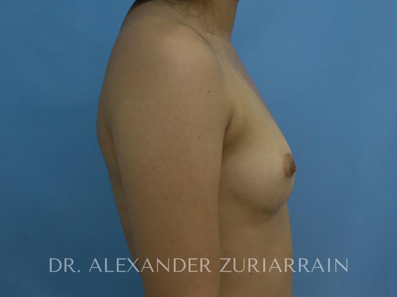 Breast augmentation before & after photo