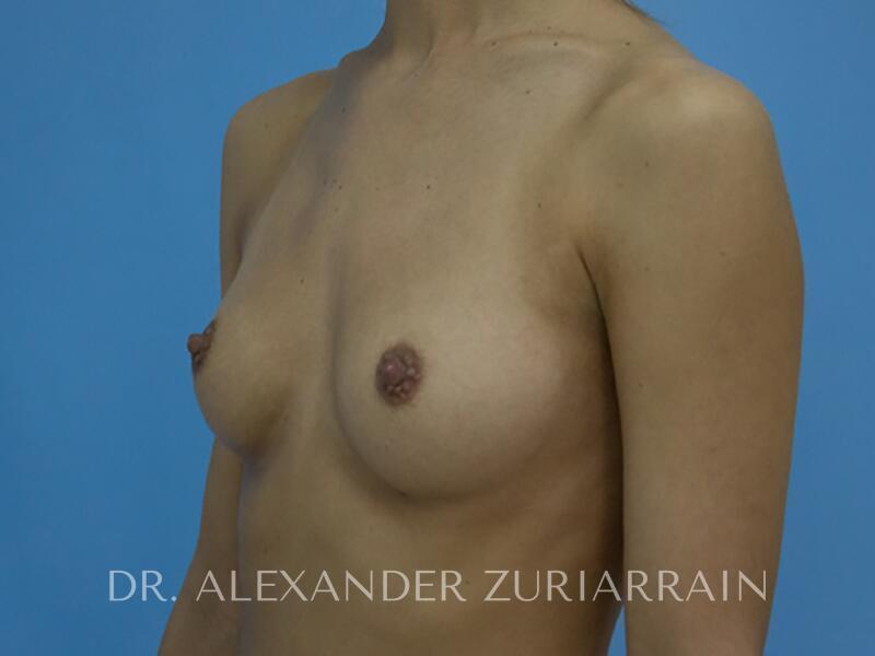 Breast augmentation before & after photo