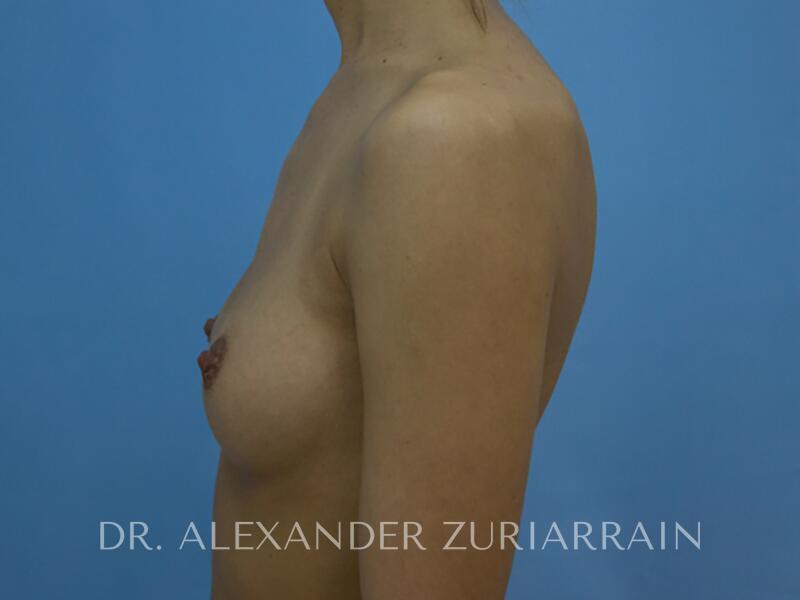 Breast augmentation before & after photo