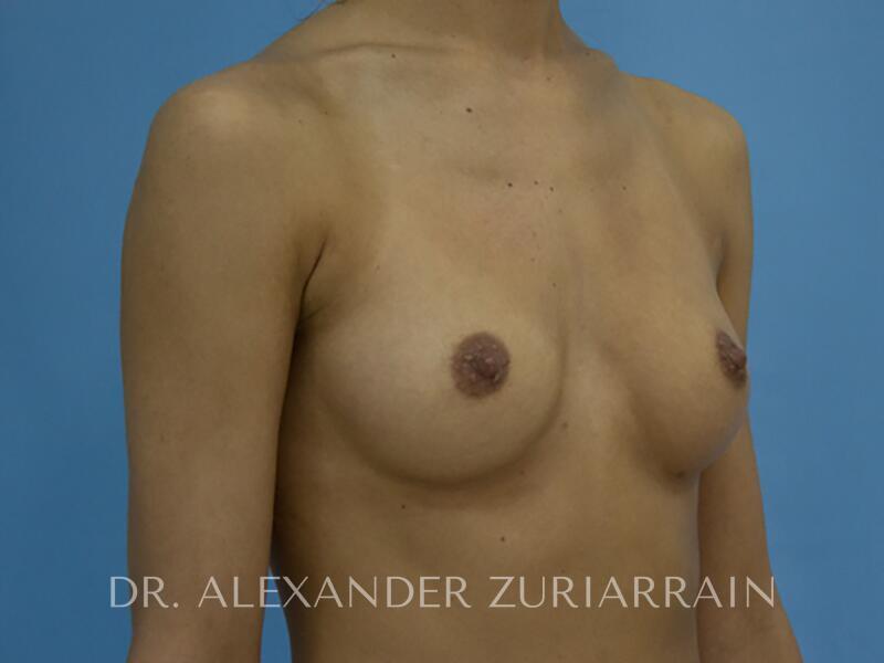 Breast augmentation before & after photo