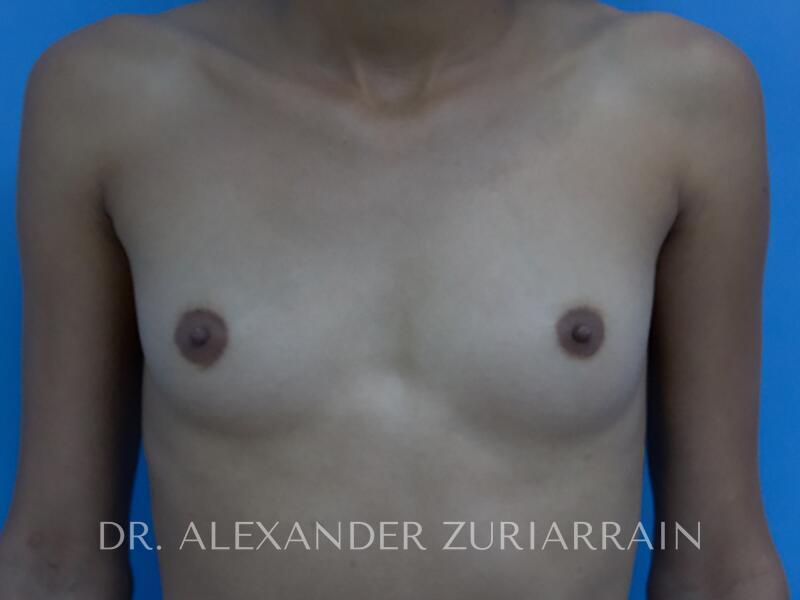 Breast augmentation before & after photo