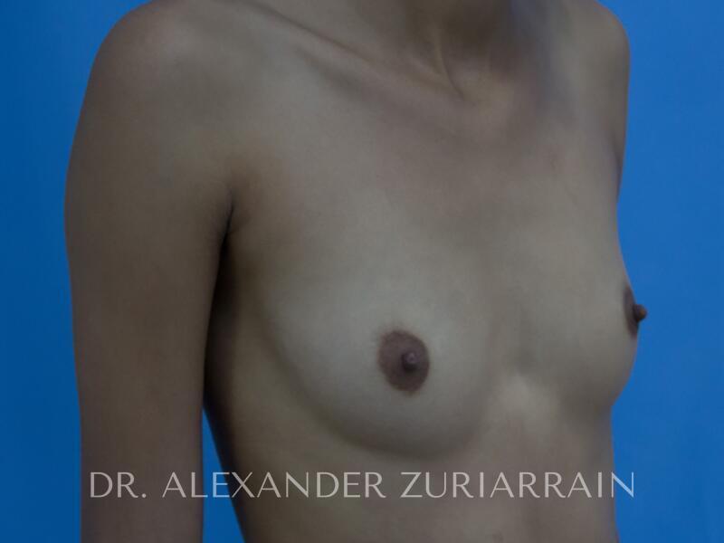 Breast augmentation before & after photo