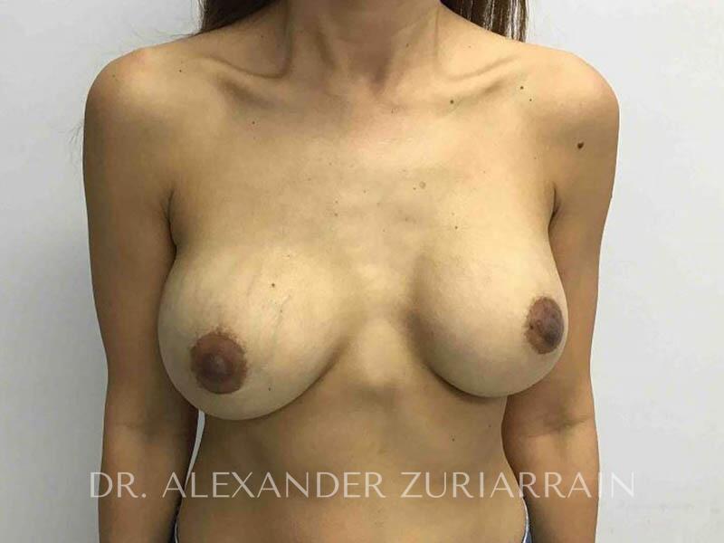 Breast augmentation before & after photo