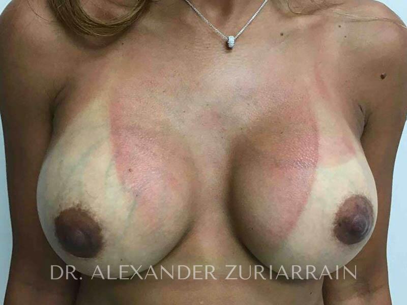 Breast augmentation before & after photo