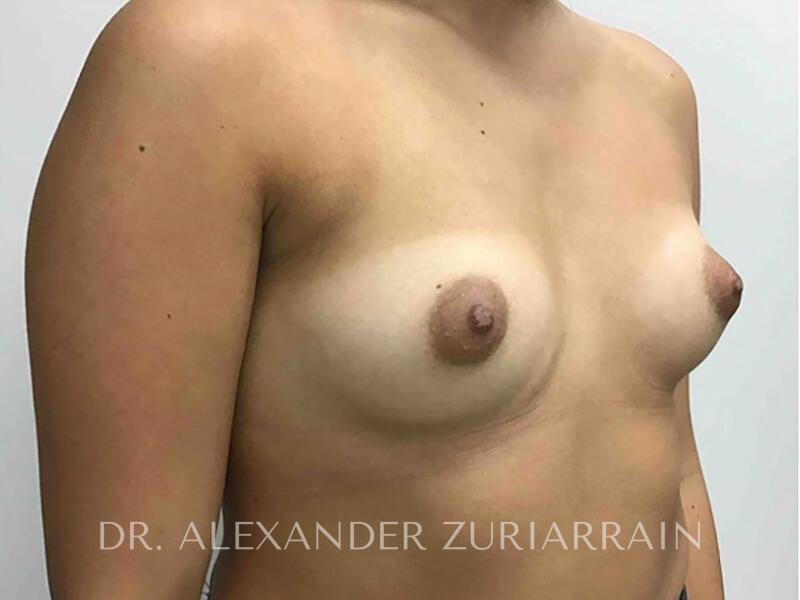 Breast augmentation before & after photo