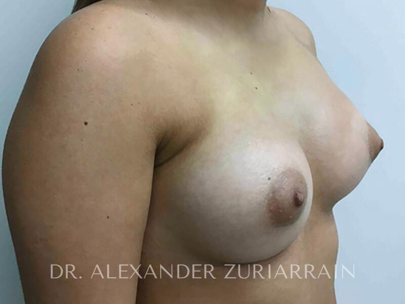 Breast augmentation before & after photo