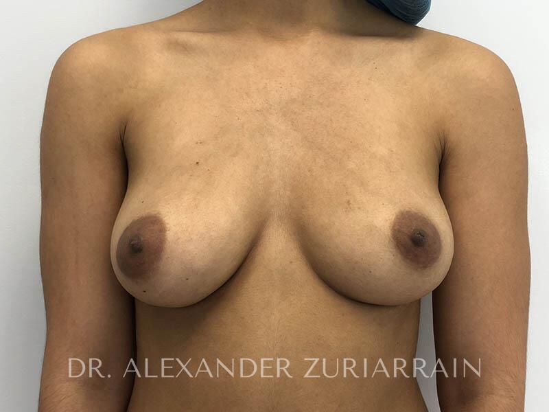 Breast augmentation before & after photo